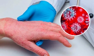 Châu Âu ghi nhận ca tử vong đậu mùa khỉ đầu tiên ở Tây Ban Nha