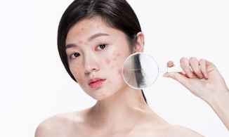 Gợi ý 5 viên uống trị mụn lành tính giúp làn da mịn màng