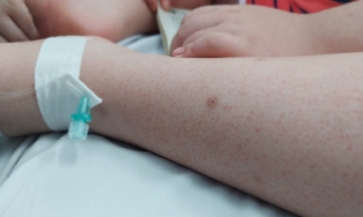 Trẻ mắc sốt xuất huyết dù hạ sốt sớm nhưng lừ đừ, tay chân lạnh có thể là dấu hiệu chuyển nặng