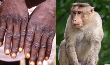 WHO xác nhận 92 ca bệnh đậu mùa khỉ trên thế giới, khả năng bùng phát cao