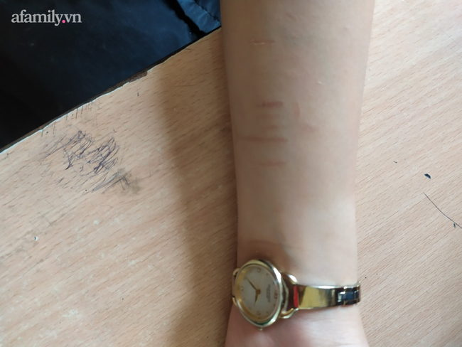 Những vết rạch trên tay học sinh được cô giáo ghi lại.