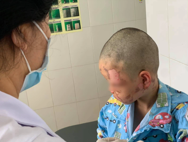 Quảng Ninh: Làm theo clip trên mạng, bé trai 10 tuổi tự mua cồn về đốt gây bỏng toàn bộ mặt - Ảnh 1