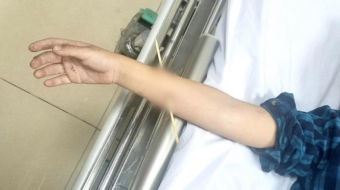 Quảng Ninh: Bé trai 6 tuổi bị que xiên thịt nướng đâm thủng cánh tay  - Ảnh 1
