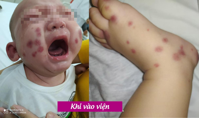 Việt Nam phát hiện và điều trị một ca bệnh cực hiếm, cả thế giới chỉ có 300-500 người. - Ảnh 1