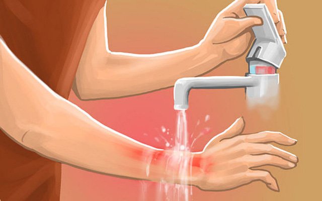 Trẻ bị bỏng nghiêm trọng và cách sơ cứu sai lầm của bố mẹ - Ảnh 5