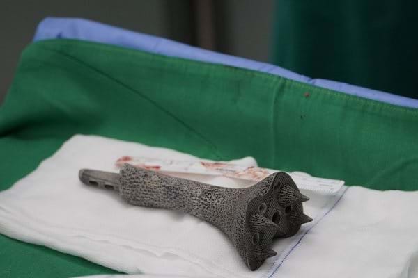 Việt Nam lần đầu tiên thực hiện thành công ghép xương bằng công nghệ 3D - Ảnh 2