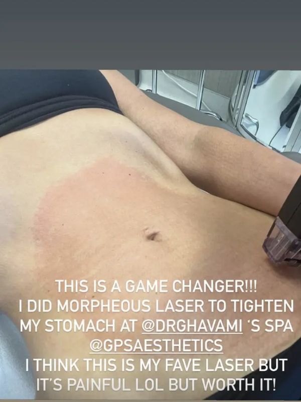 Kim Kardashian chia sẻ bức ảnh chụp bụng sau quá trình điều trị trên Instagram