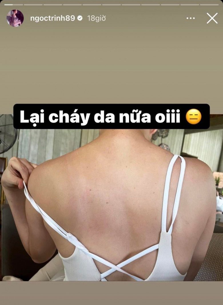 Làn da cháy nắng của Ngọc Trinh được cô chia sẻ trên story Instagram trước đó