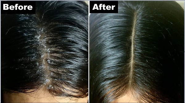 Ưu điểm của dầu gội trị gàu Nizoral giúp sạch gàu và ngăn ngừa bệnh lý da đầu.