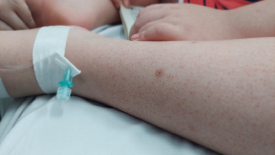 BS khuyến cáo: Trẻ mắc sốt xuất huyết hết sốt ngày thứ 4 có thể là dấu hiệu chuyển nặng - Ảnh minh họa