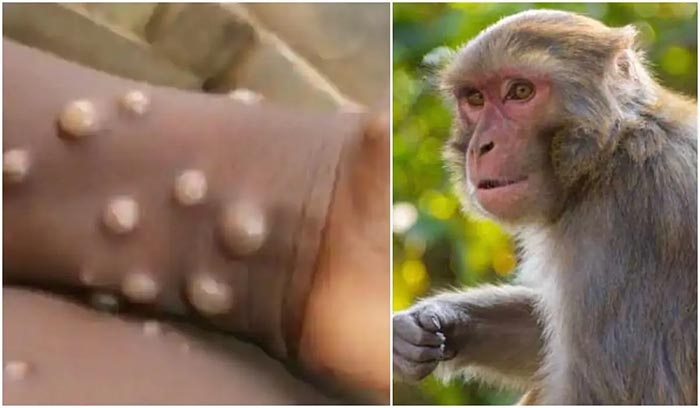 WHO xác nhận 92 ca bệnh đậu mùa khỉ trên thế giới, khả năng bùng phát cao - Ảnh 1