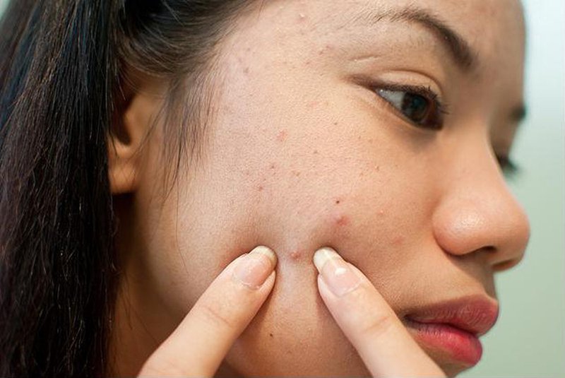 Tự nặn mụn sẽ càng khiến cho làn da của bạn bùng mụn nhanh chóng