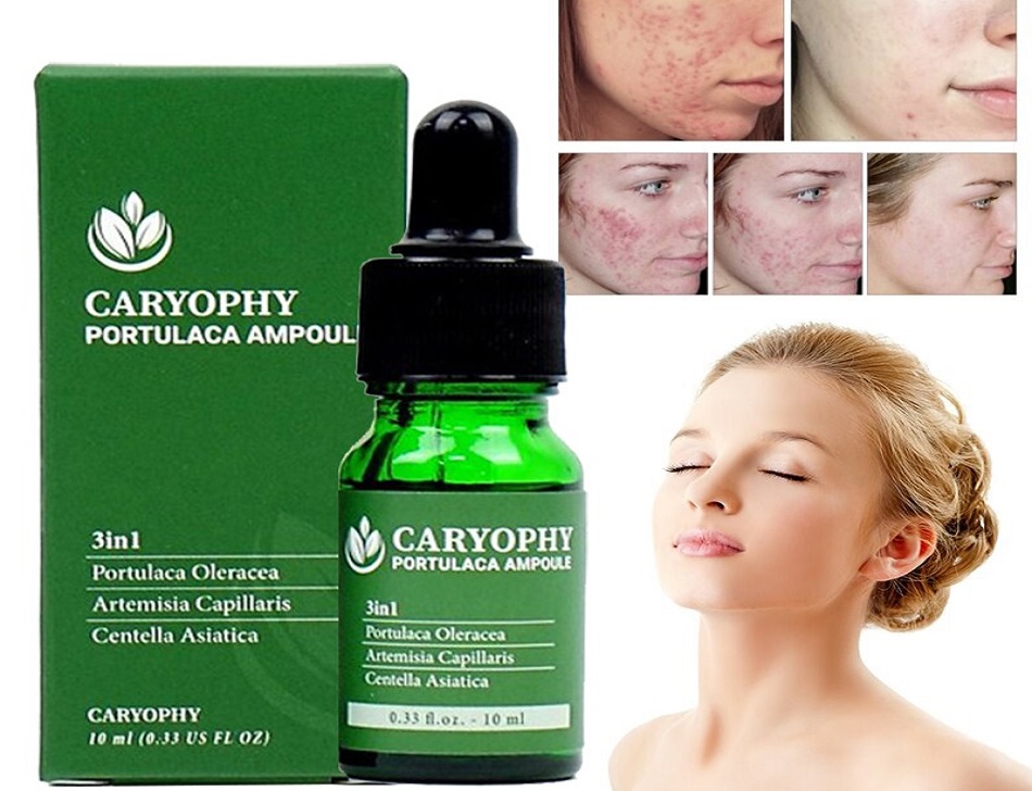 Serum trị mụn Caryophy có công dụng trị mụn, xóa thâm và cung cấp độ ẩm cho làn da luôn mềm mịn và trắng sáng.