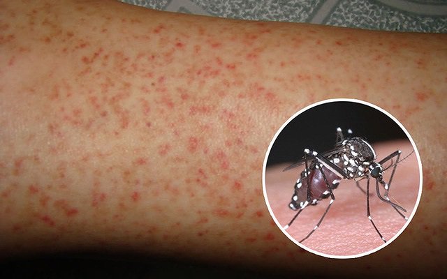 Cách phân biệt Covid-19 và sốt xuất huyết