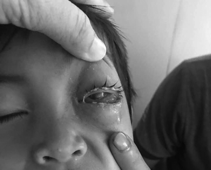 Quảng Bình: Bé trai bị cò mổ hỏng mắt. Ảnh: VN Express.