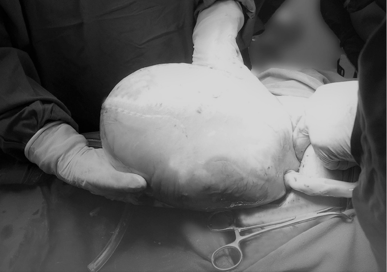 Hình ảnh em bé chào đời còn nguyên trong bọc ối - Ảnh: BVCC