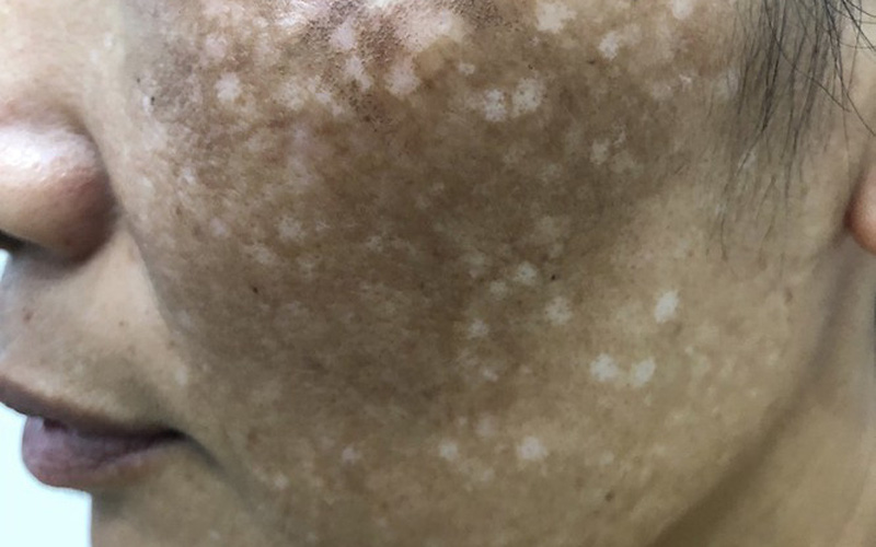 Vùng da của bệnh nhân bị sẹo trắng loang lổ sau khi điều trị nám (Ảnh: BVCC).
