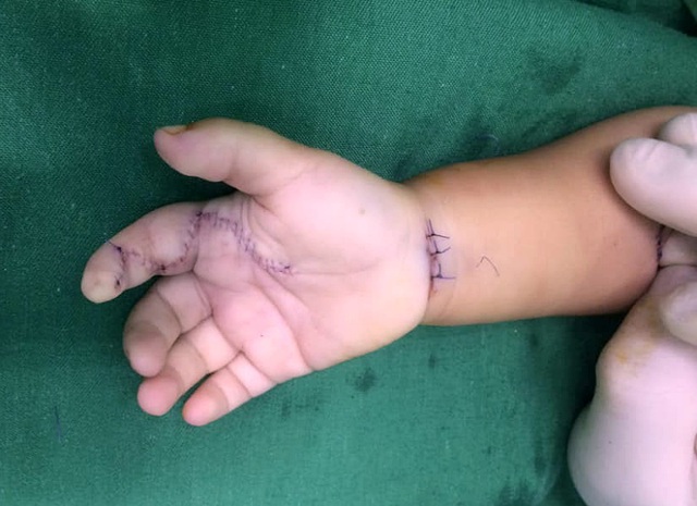 Các bác sĩ phẫu thuật phục hồi chức năng bàn tay cho bé.