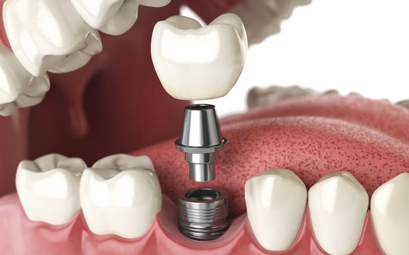 Bệnh nhân Mỹ được bác sĩ Việt cứu hàm răng sau khi 3 nước từ chối