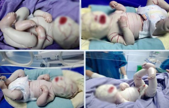 Bé trai mắc chứng da vảy cá toàn thân ở Quảng Ninh. Chiều 13-10, một em bé sinh ra ở Hà Giang cũng bị tình trạng tương tự - Ảnh: Bệnh viện Sản nhi Quảng Ninh