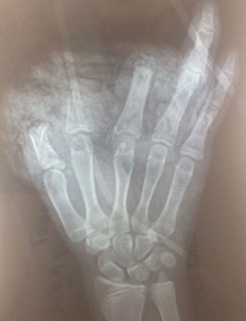 Phim chụp Xquang bàn tay trái bị cụt ngón 1,2,3 của bệnh nhi.