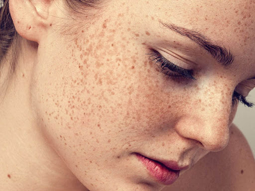 Các tia UV là nguyên nhân gây ra các tác động xấu cho da như: Sạm, nám da, xuất hiện tàn nhan và thúc đẩy nhanh quá trình lão hóa.