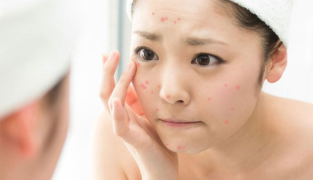 Đắp mặt nạ dưỡng da khi nổi mụn có thể khiến tình trạng mụn ngày càng nặng hơn.