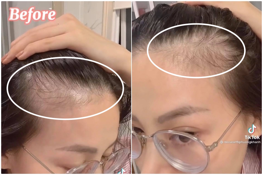 Tình trạng rụng tóc khá tệ của Phương Khánh 6 tháng trước. Cô nàng bị rụng tóc nhiều đến mức lộ cả những mảng da đầu trắng, tóc con thì thưa thớt và rất yếu