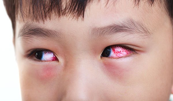 Đau mắt đỏ là một trong những bệnh lý về mắt thuờng gặp mùa bão.
