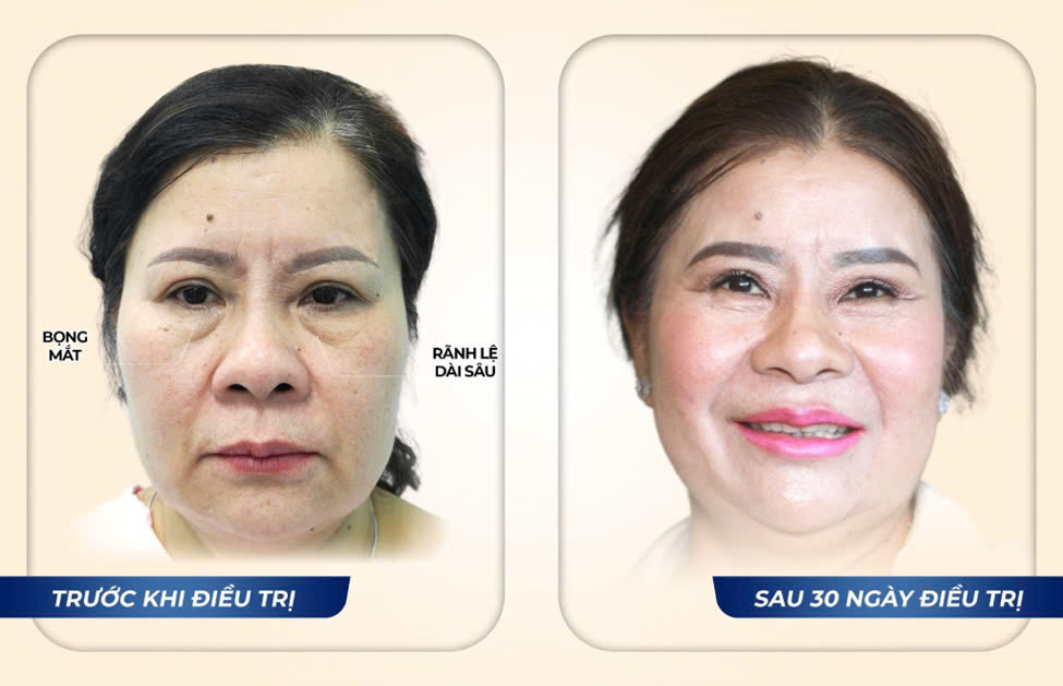 Phương pháp điều trị bọng mắt, quầng thâm hiệu quả từ chuyên gia  - Ảnh 3