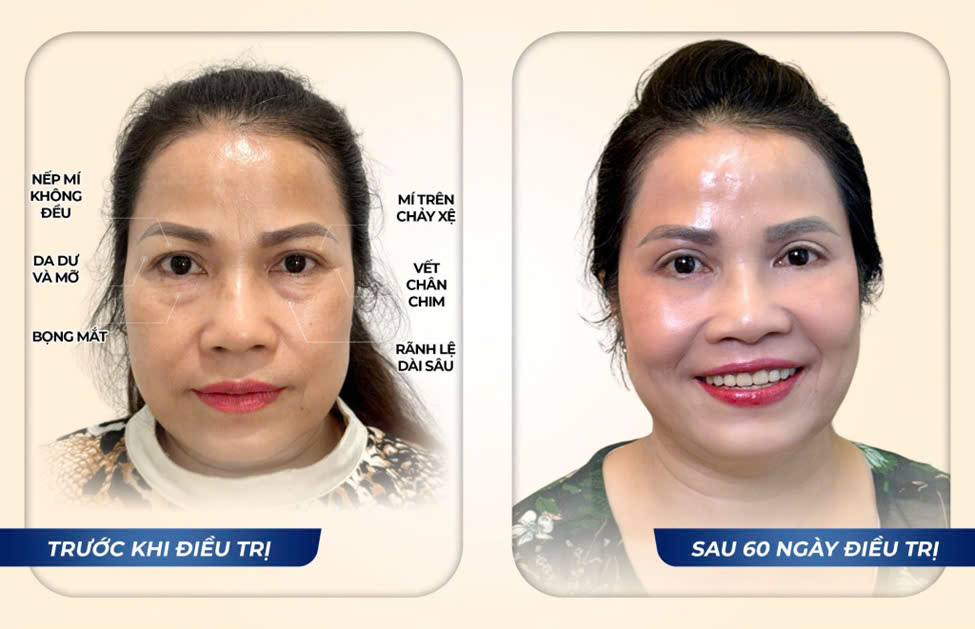 Phương pháp điều trị bọng mắt, quầng thâm hiệu quả từ chuyên gia  - Ảnh 4