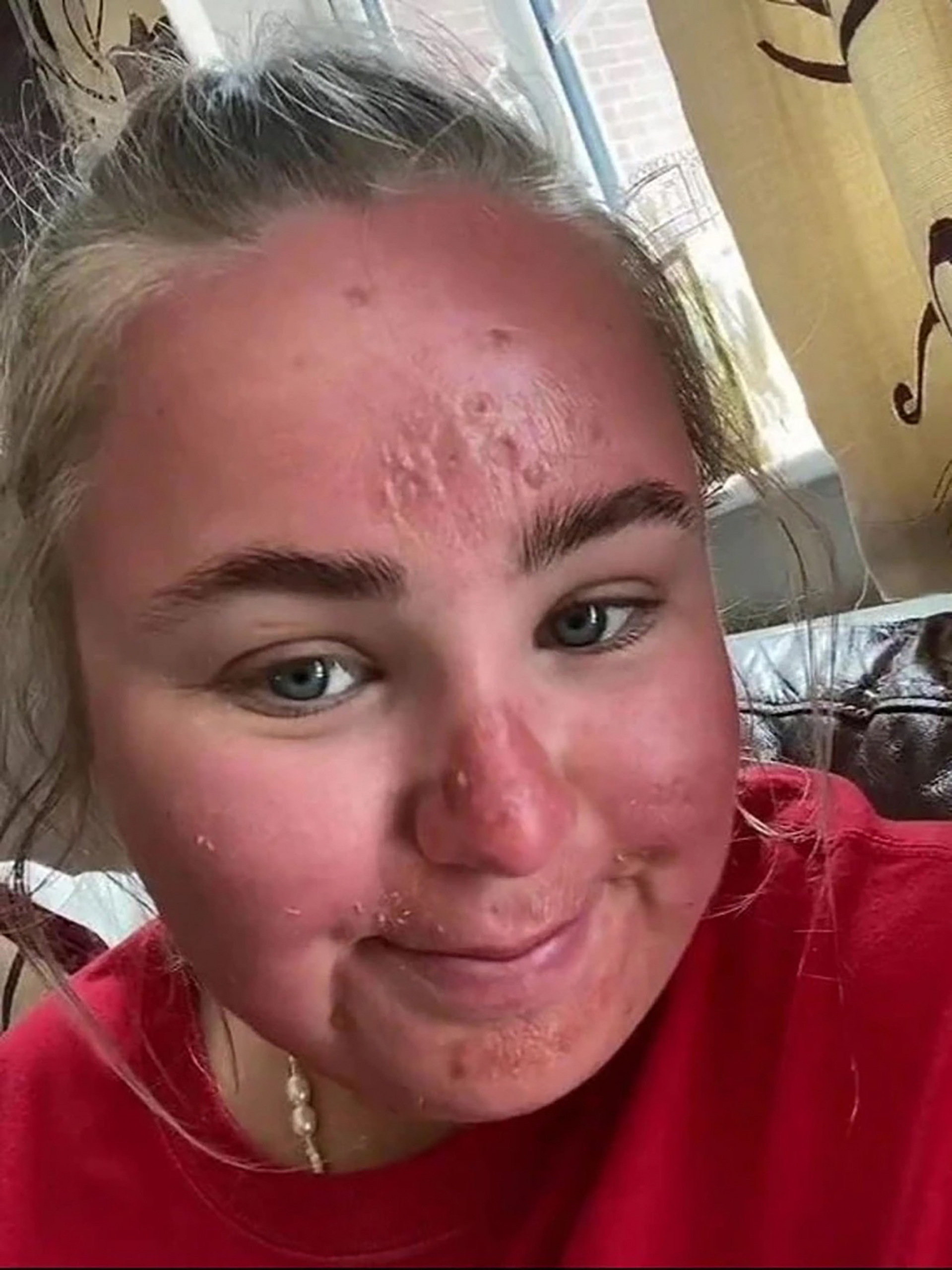 Eva Jone từng trải qua những vết phồng rộp trên mặt và say nắng.