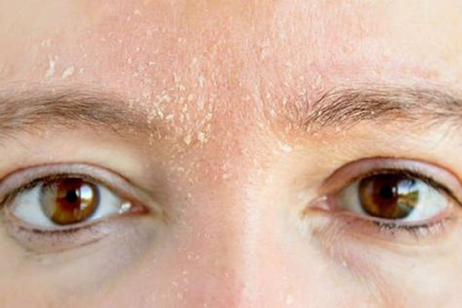 Làn da khô thường không có độ bóng mướt và nhiều nếp nhăn, khi dưỡng da thường hút ẩm rất nhanh - Ảnh 2
