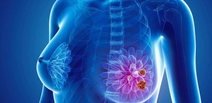 Kết hợp vaccine và thuốc miễn dịch để chống ung thư vú