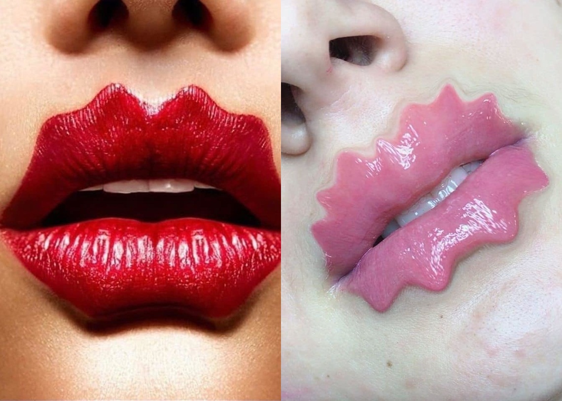 Trào lưu tiêm filler tạo dáng môi