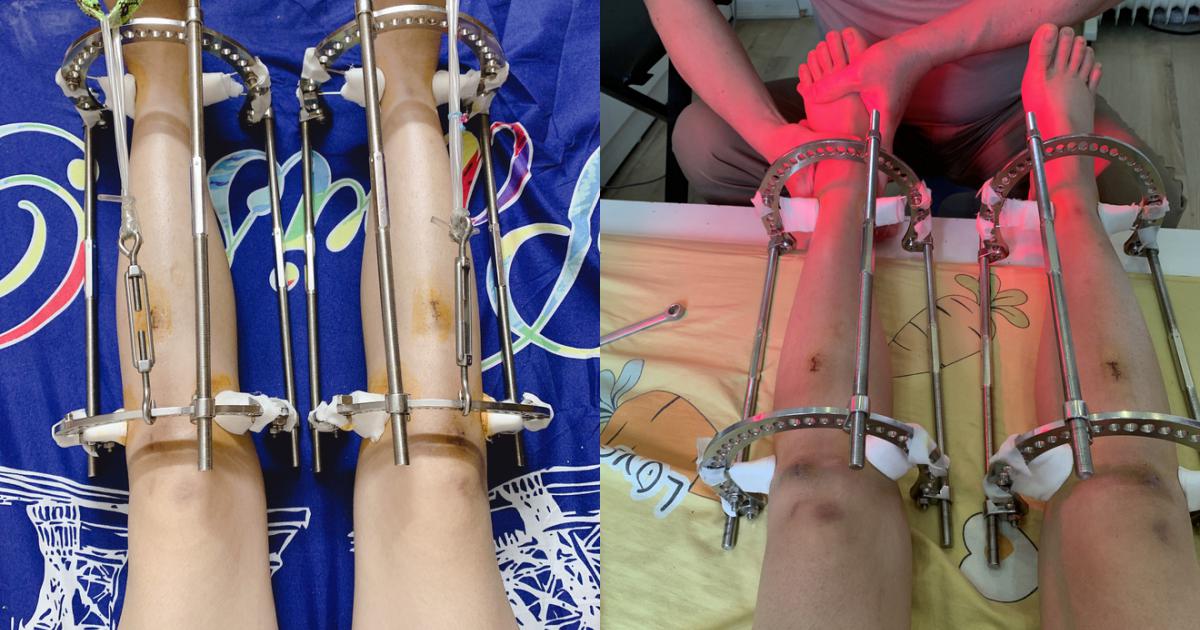 Cô gái chia sẻ hành trình phẫu thuật kéo dài chân thêm 7cm lên TikTok