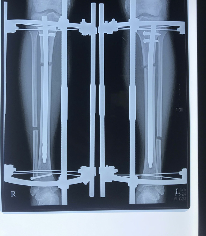 Hyan mong muốn kéo dài chân thêm 7-8cm. Chỉ số này còn phụ thuộc vào sự luyện tập chăm chỉ của bệnh nhân hậu phẫu. Hiện sau 30 ngày, chân Hyan đã dài thêm 3cm. Ảnhnh chụp X-quang sau khi tách xương được 2 ngày.