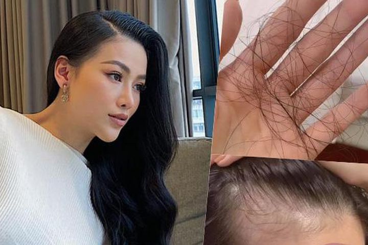 Cách trị rụng tóc của H'Hen Niê, Phương Khánh và các Hoa hậu, Á hậu Việt