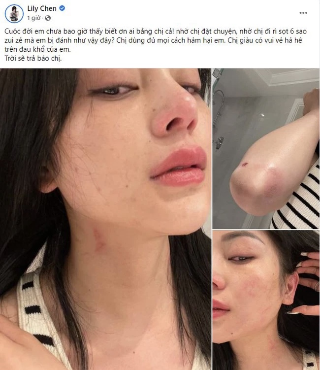 Lily Chen đăng ảnh thương tích đầy mặt, úp mở chuyện bị đánh do Ngọc Trinh.