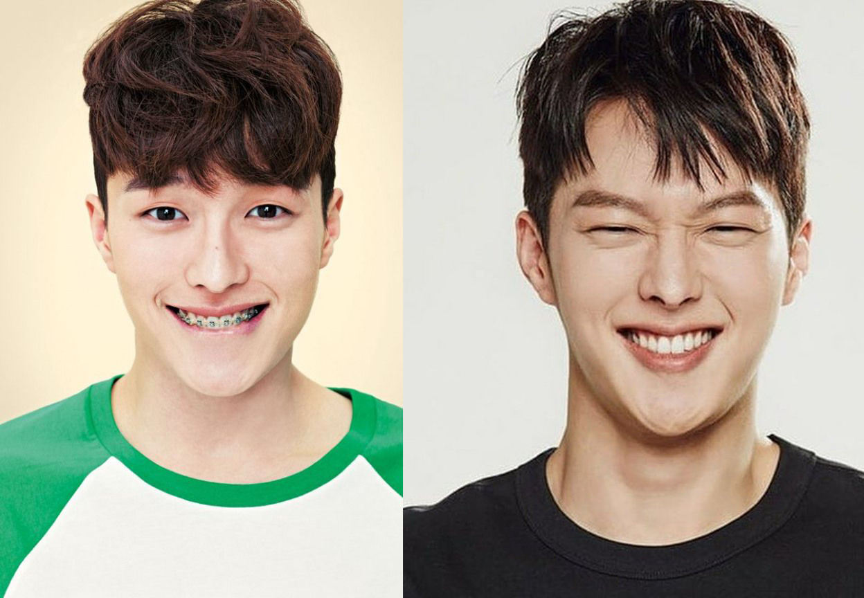 Jang Ki Yong trước và sau khi niềng răng. 
