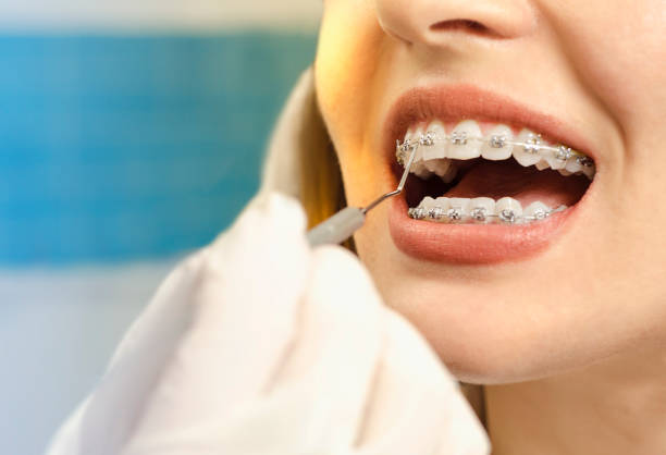 Niềng răng là phương pháp thẩm mỹ được nhiều người khuyên thực hiện khi nụ cười bạn kém thu hút.