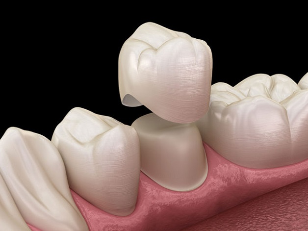 Phương pháp bọc răng sứ hiện đại, nha sĩ sẽ mài răng thật của bạn, tạo diện tích để lắp răng sứ vào theo tiêu chuẩn thẩm mỹ cao.