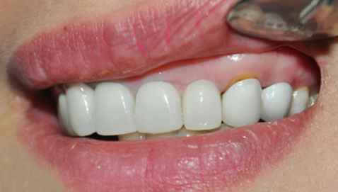 Trường hợp mão răng bị lỏng, trượt khỏi chân răng rất phổ biến.