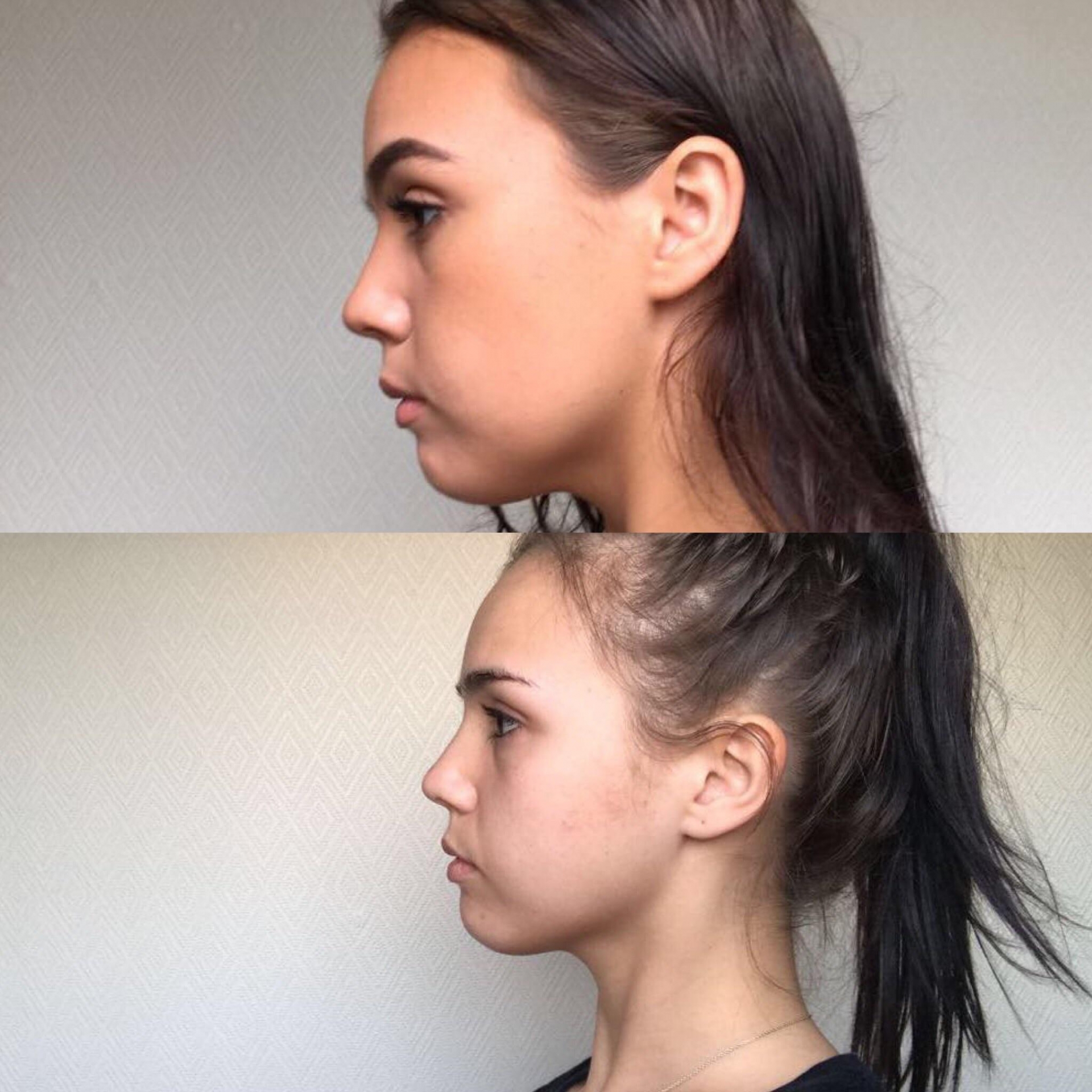 Phương pháp Mewing: Đặt lưỡi lên vòm họng cũng có thể  cải thiện thẩm mỹ gương mặt - Ảnh 2