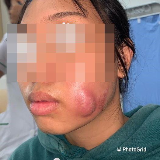 Tạo má lúm đồng tiền làm duyên ở cơ sở không uy tín, thiếu nữ 16 tuổi bị sưng vù mặt