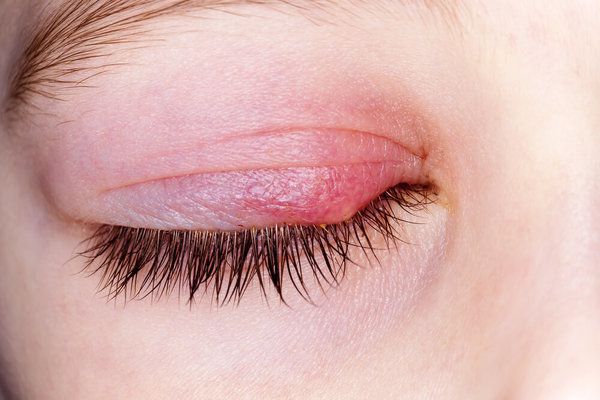 Làm thế nào để loại bỏ mụn trên mí mắt?