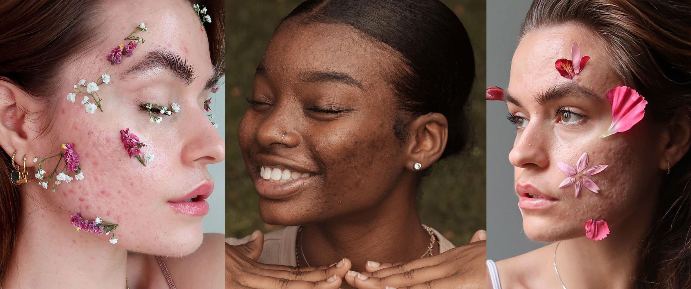 Những điều cần biết trước khi quyết định sử dụng xà phòng trị mụn