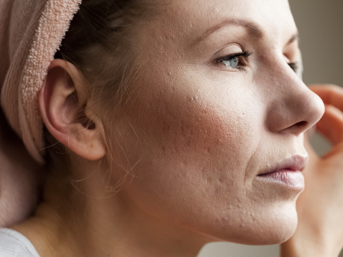 4 cách trị mụn rỗ hiệu quả ai cũng cần biết