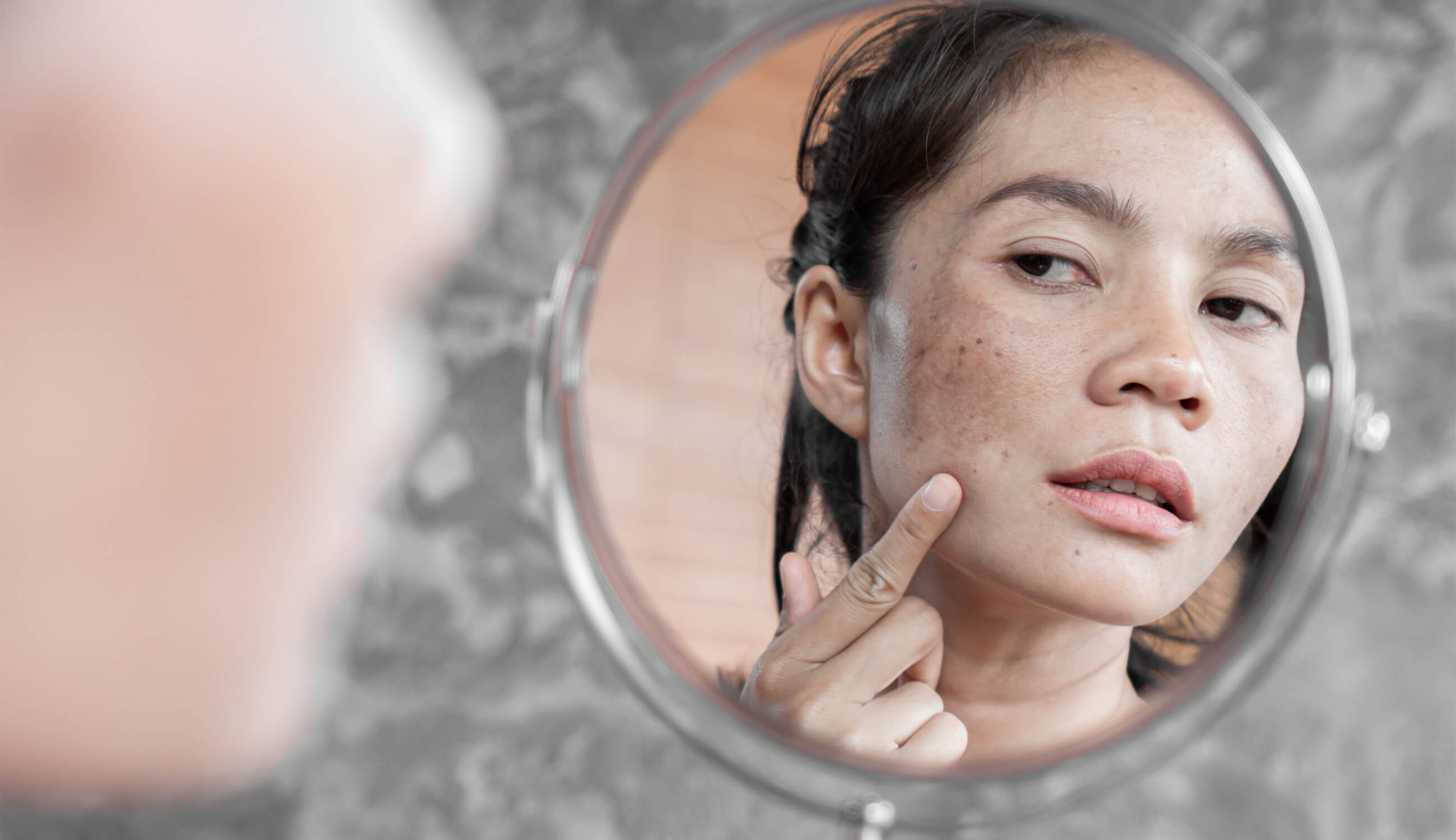 Top 5 cách trị nám nắng đơn giản mà hiệu quả ngay tại nhà bạn nên thử