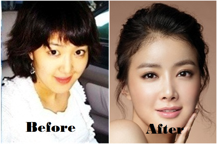 Hình ảnh trước và sau khi Lee Si Young phẫu thuật thẩm mỹ thật sự rất khác nhau